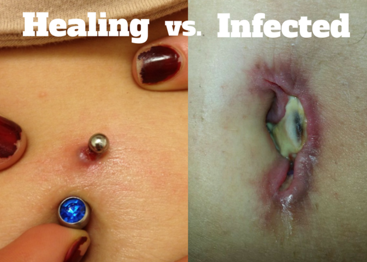 Helbredende navle piercing vs infisert
