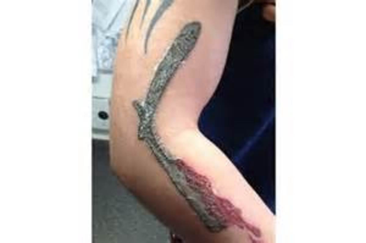 Kopás tetováláson. Úgy tűnik, hogy a bőr komoly reakciót vált ki a használt tintával szemben. Ez a tetoválás minden valószínűség szerint jelentős károkat fog okozni.