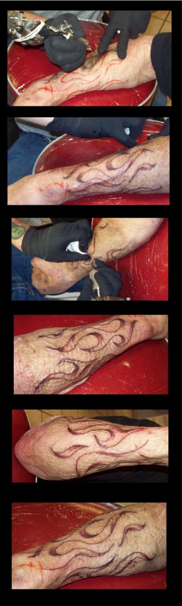tetoválás-égési hegek