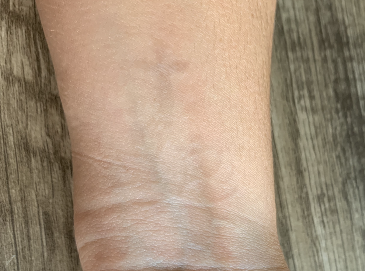 Som nevnt fullførte jeg ikke behandlingen og likte det falmede utseendet. Dette bildet er etter 11 totale behandlinger og 2 år etter laserbehandling av noe slag.